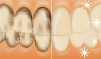 クリーニング・予防歯科治療